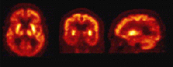 [Dopa imaging of the brain with PET]