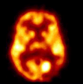 [PET of a brain tumor]