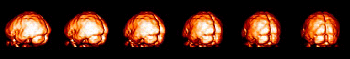[Sequence of rotating 3D PET brain images]