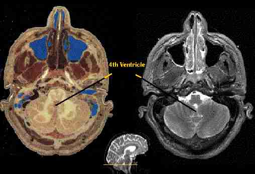 Visible Human: Ventricular System - Fourth Ventricle