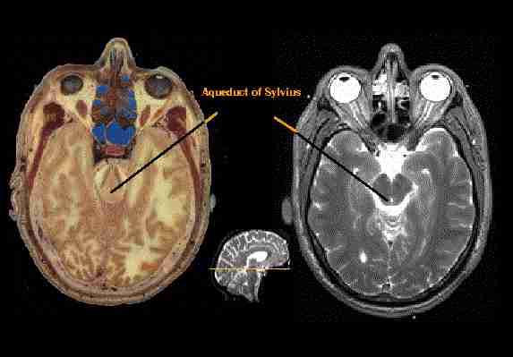 visible-human-ventricular-system-cerebral-aquaduct