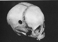 Were mystery holes in skulls an ancient aspirin?